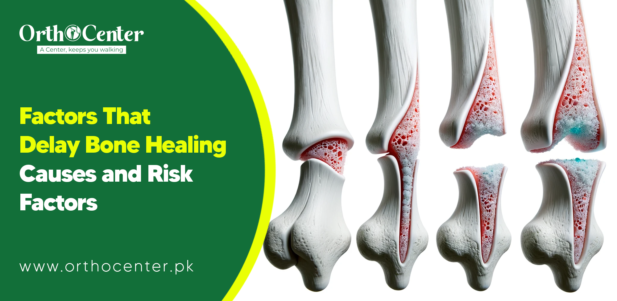 delay bone healing